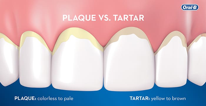 can water flossers remove tartar?